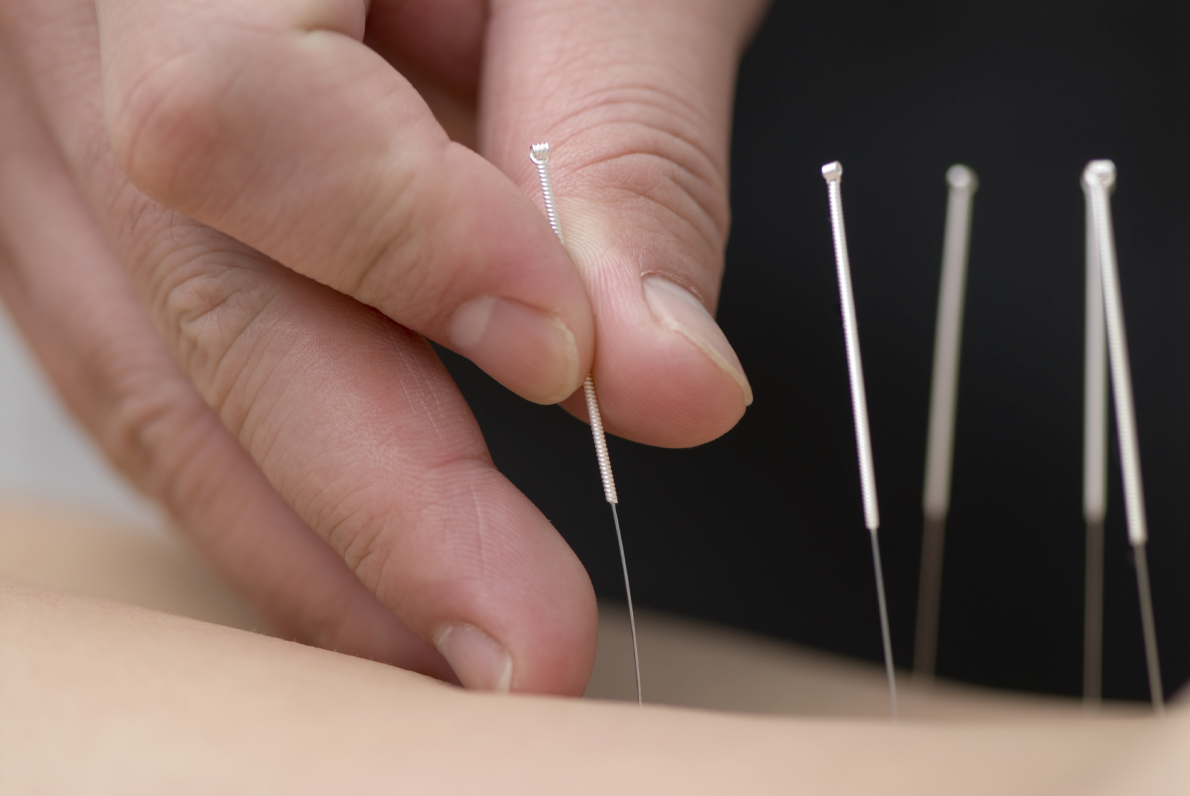 lisburn physiotherapy back2health acupuncture